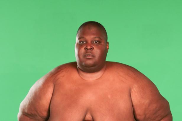 Too Large Before and After Photos | Inside TLC | TLC.com