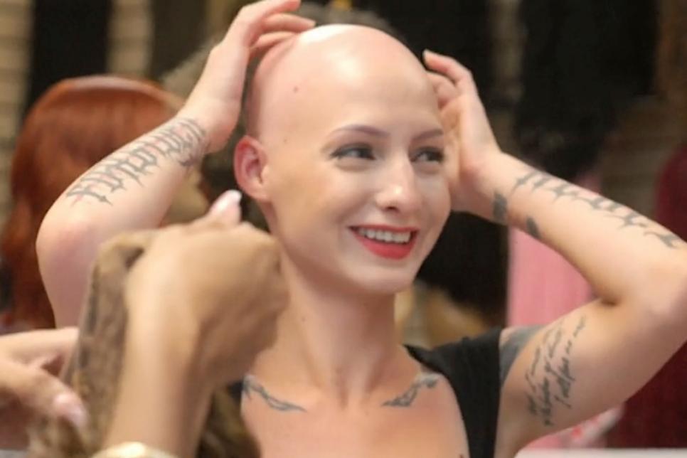 Understanding Alopecia